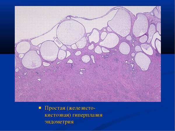 Классификация и особенности лечения железистой гиперплазия эндометрия