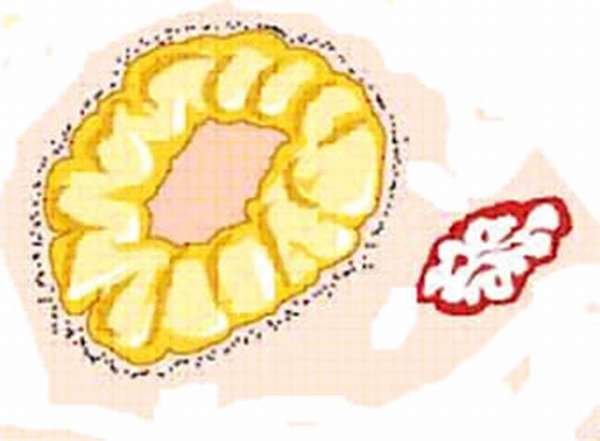 Жёлтое тело яичника при беременности на фото