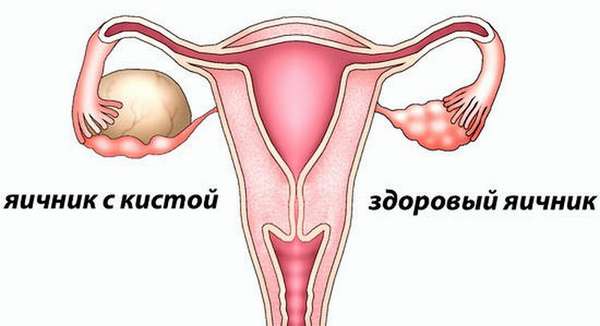 Киста яичника во время беременности нередко диагностируется у женщин.