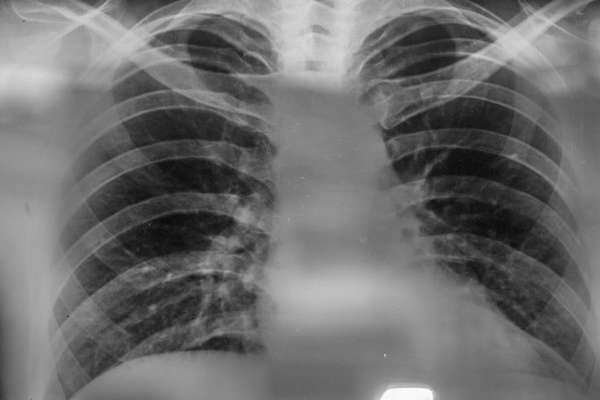 Для диагностики недуга чаще всего назначают рентген.