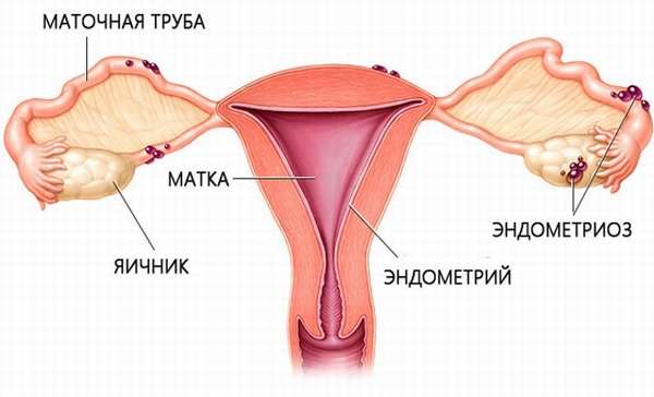 Появление эндометриоза на парных половых железах женщины