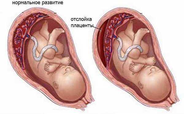 Отслоение плаценты на ранних сроках беременности может иметь разные причины.