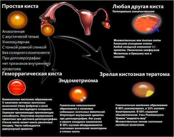 Лечение геморрагической кисты яичника
