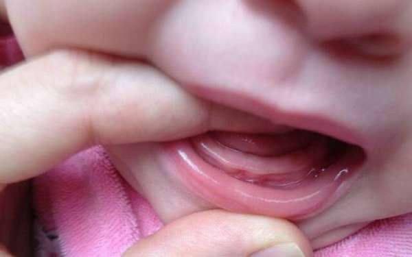 на фото видно, как режутся зубы у грудничков.