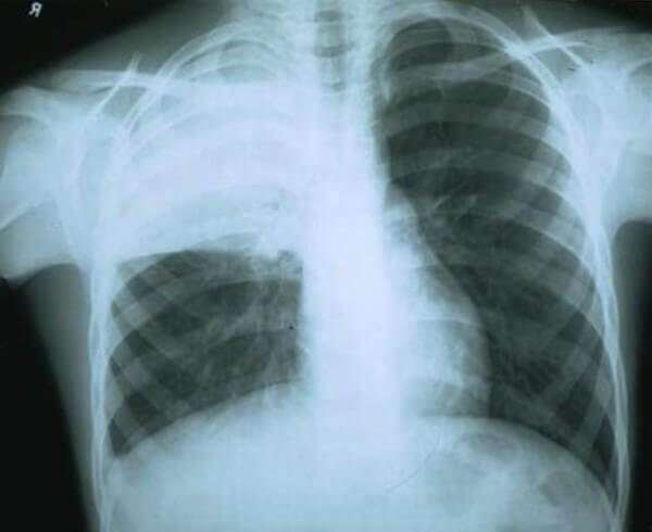 Снимок легких после пневмонии фото thumbnail