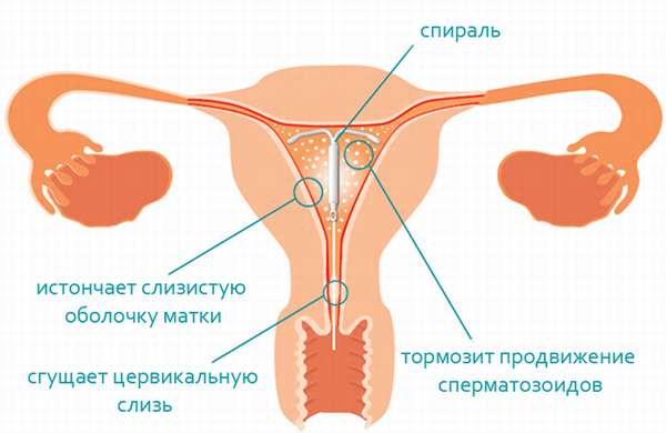 Спираль Мирена при эндометриозе: отзывы специалистов