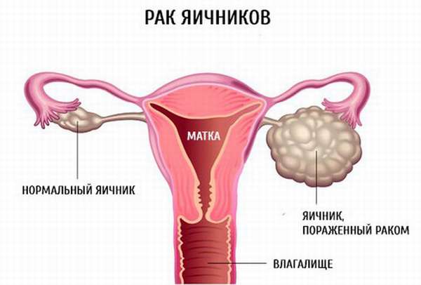 Признаки рака яичников у женщин и первые симптомы заболевания