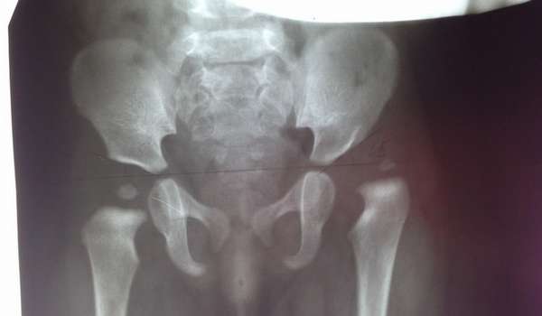 После 3-х месяцев малышам для диагностики также могут делать рентген.