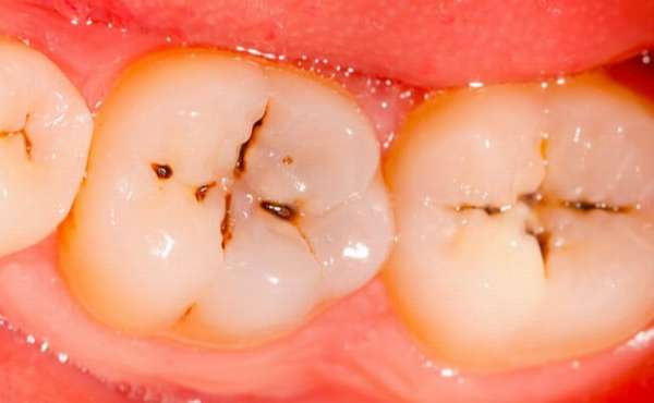 Зубы ребенка очень сильно подвержены кариесу.