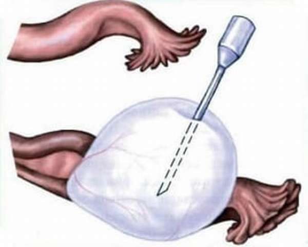 Как делают пункцию яичника